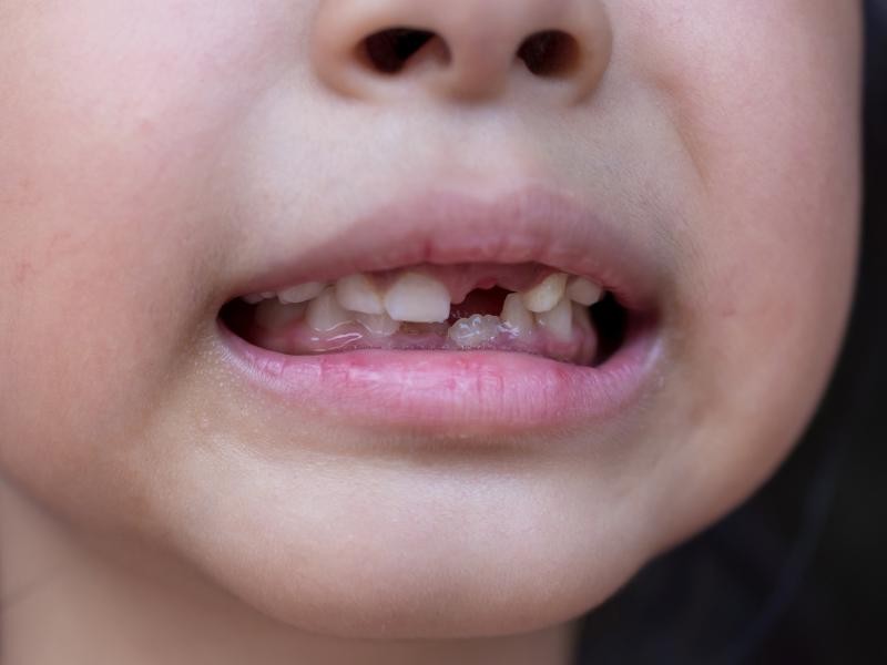 Dente Quebrado em Criança: O que Fazer?