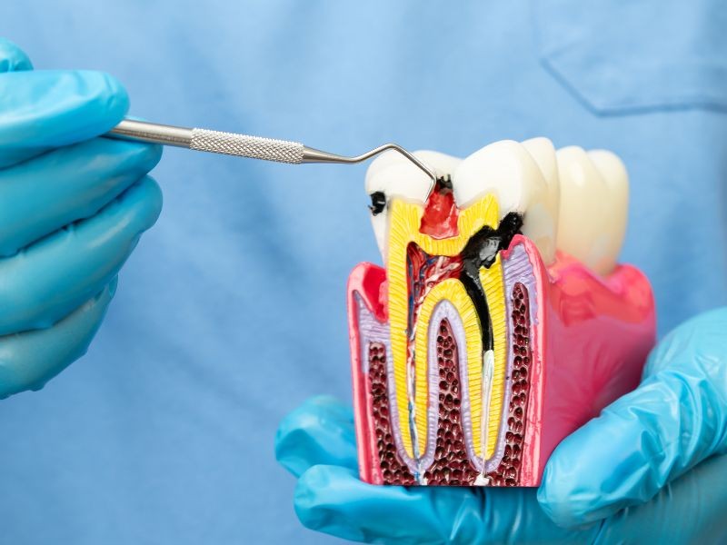 O Tratamento de Canal pode Salvar um Dente?