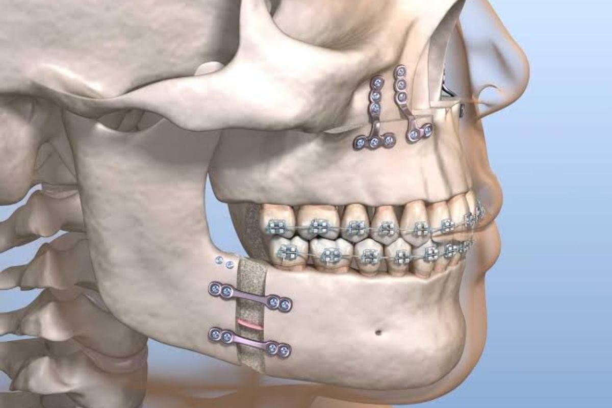 Cirurgia Ortognática