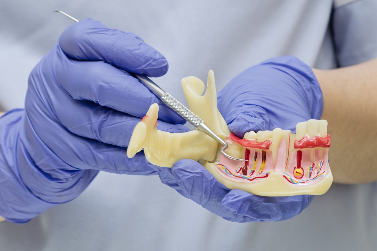 Tratamento Periodontia