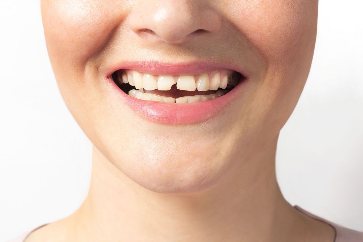 Tratamento para Dente Quebrado