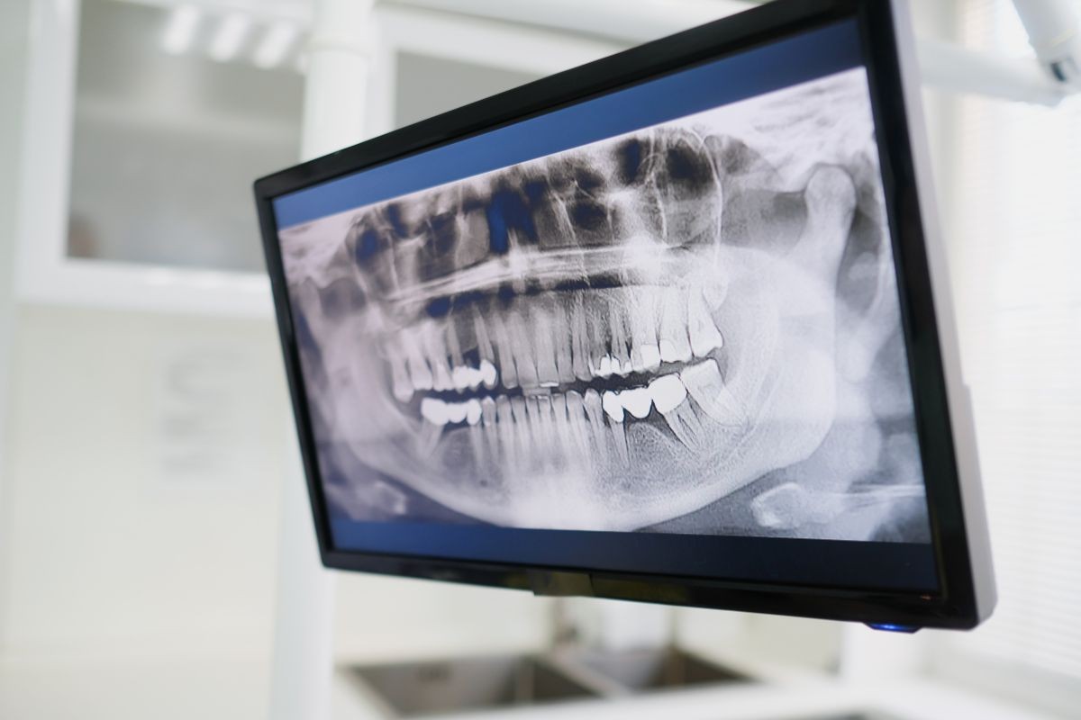 Raio-X Periapical Digital