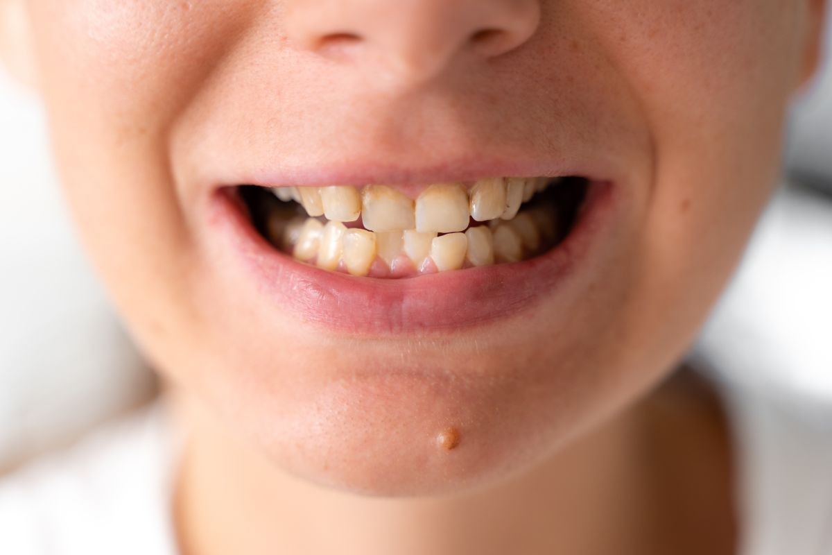 Tratamento para Dentes Tortos