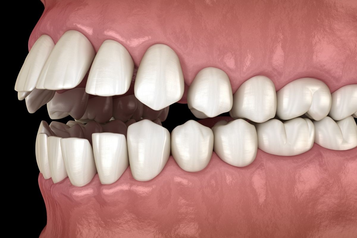 Exame de Ajuste Oclusal Digital